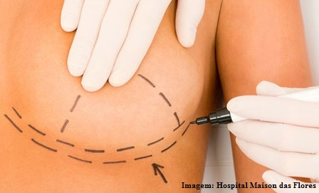 Você sabia que a cirurgia para redução de mamas pode ter cobertura total, dependendo do plano de saúde?